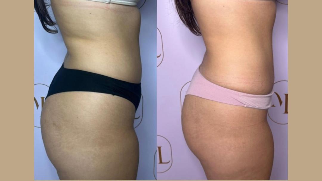 Personalizovani Attento tretmani tela - paket od 6 tretmana - Attento Aesthetic, Beograd Tretmani tela Telo Tretmani tela, Beograd, Zvezdara