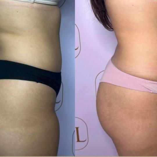 Attento Aesthetic #beograd Tretmani tela Personalizovani Attento tretmani tela - paket od 6 tretmana