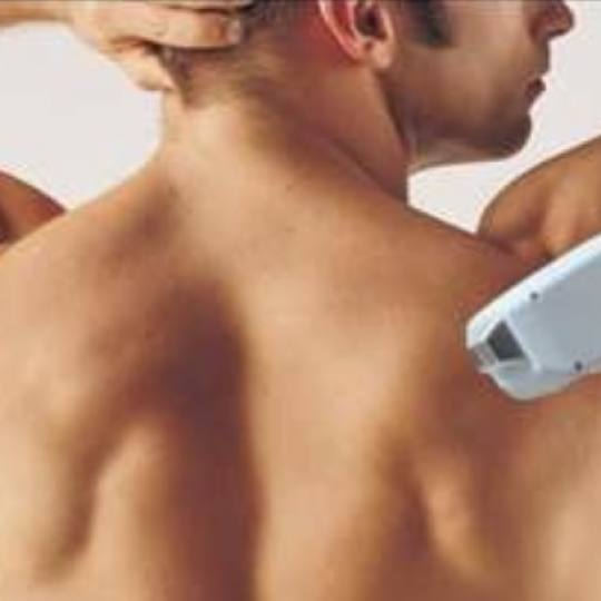 Helios #kikinda Laserska epilacija za muškace - leđa