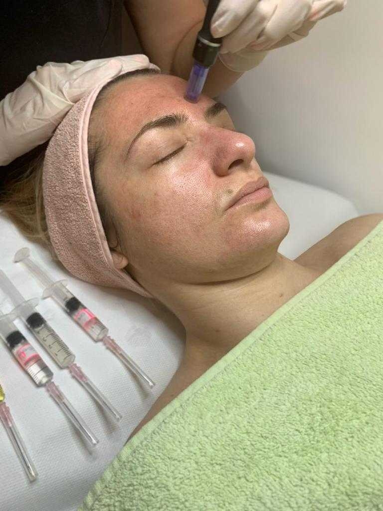 Sensus #beograd Dermaroler i dermapen Dermapen - za aknoznu kožu lica