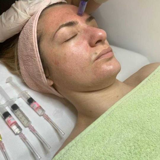 Sensus #beograd Dermaroler i dermapen Dermapen - za aknoznu kožu lica