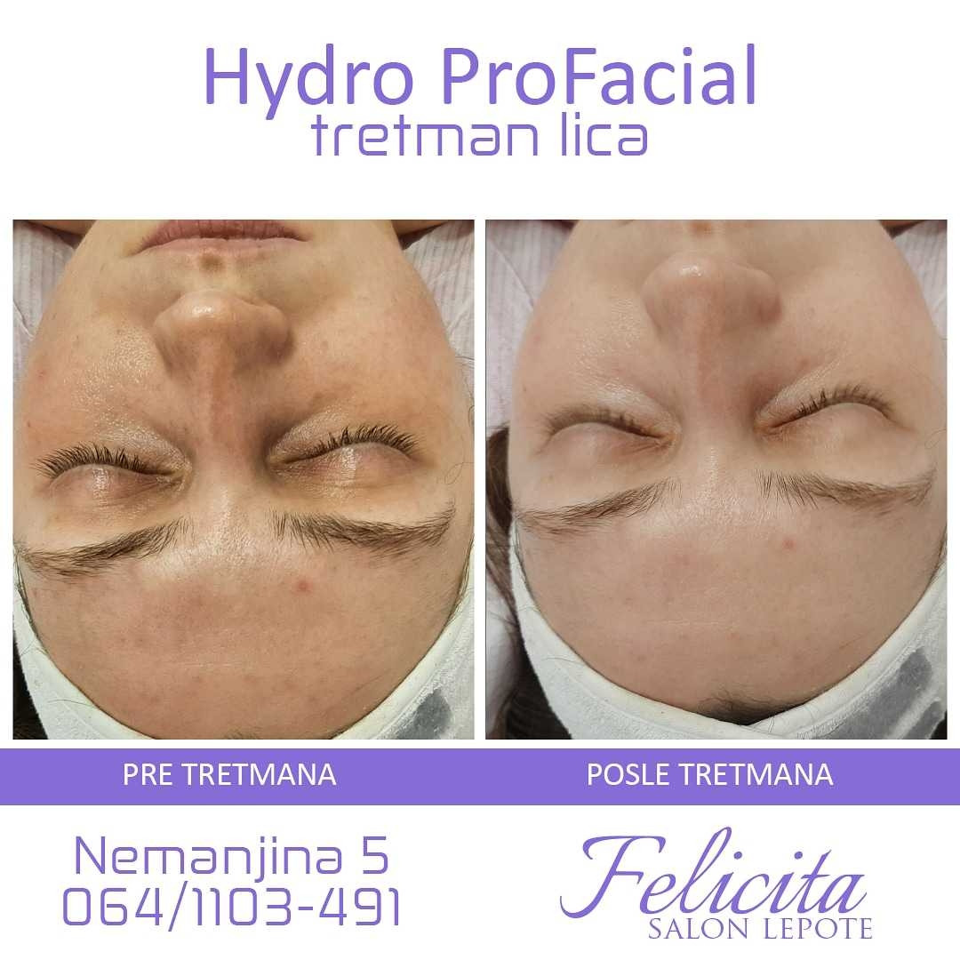 Felicita #beograd Tretman lica Hydro Pro Facial 7in1