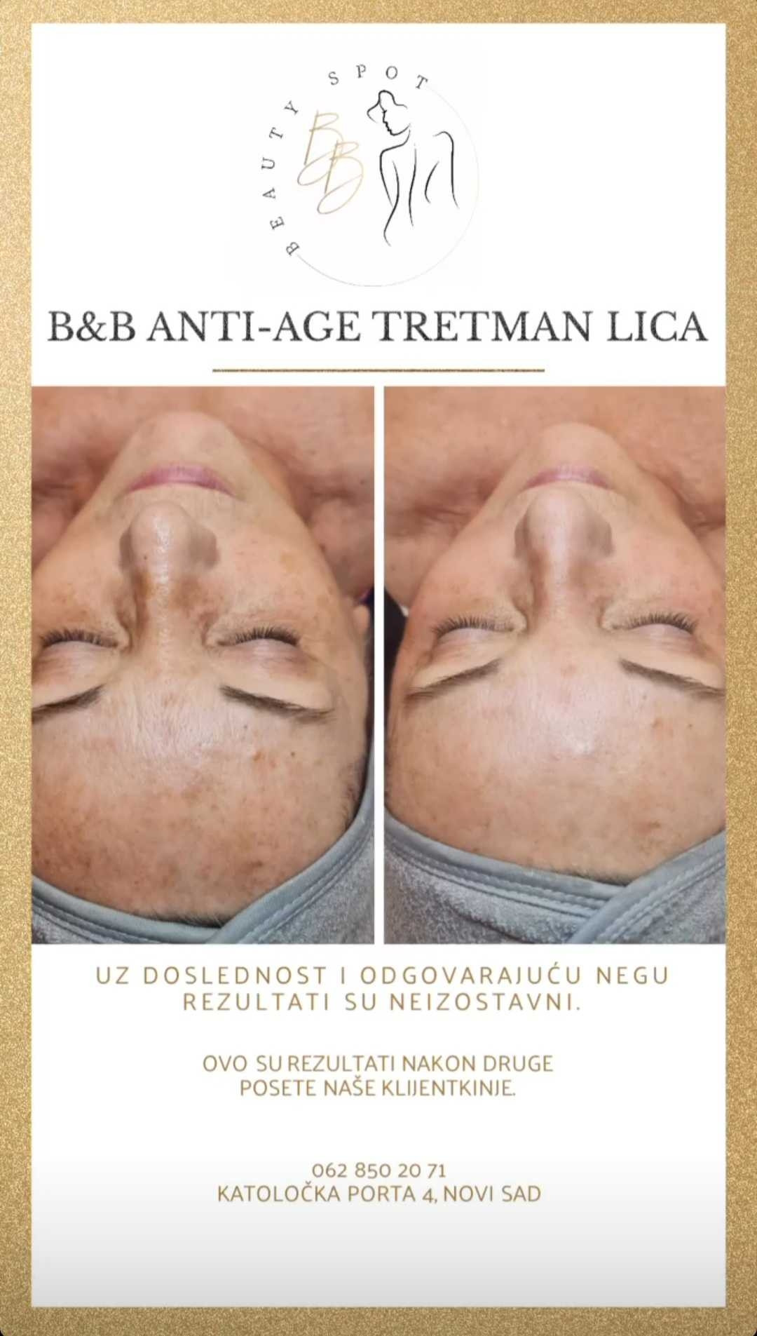 B&B Beauty Spot #novisad Tretman lica