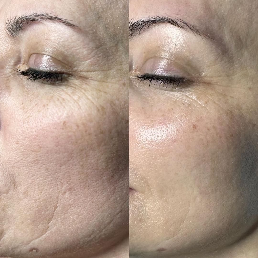Hifu tretman - lice - Beauty Glam House, Niš Tretmani protiv bora Lice Tretmani protiv bora, Niš, Medijana