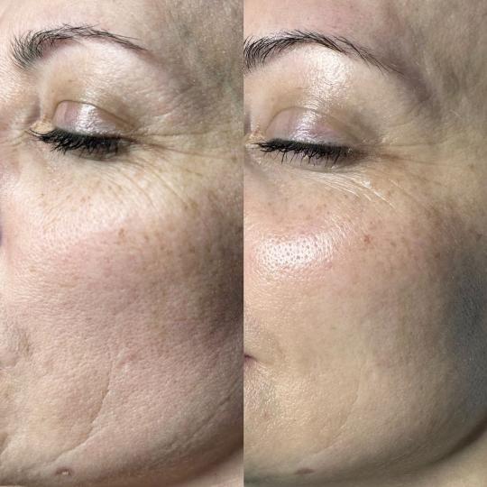 Beauty Glam House #nis Tretmani protiv bora Hifu tretman - lice HIFU (High Intensity Focused Ultraso