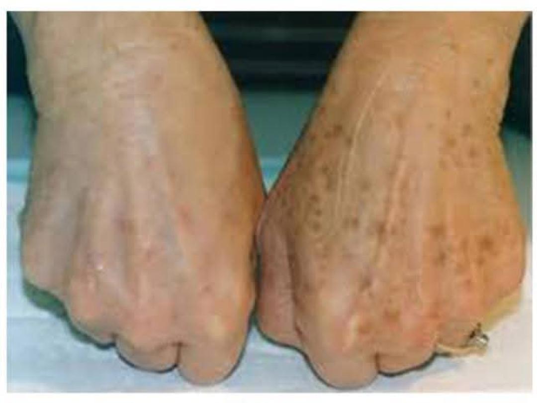 Hemijski piling lica + ruku - Astradas 2, Beograd Piling lica Lice Piling lica, Beograd, Novi Beograd blokovi, Belville, Savski kej