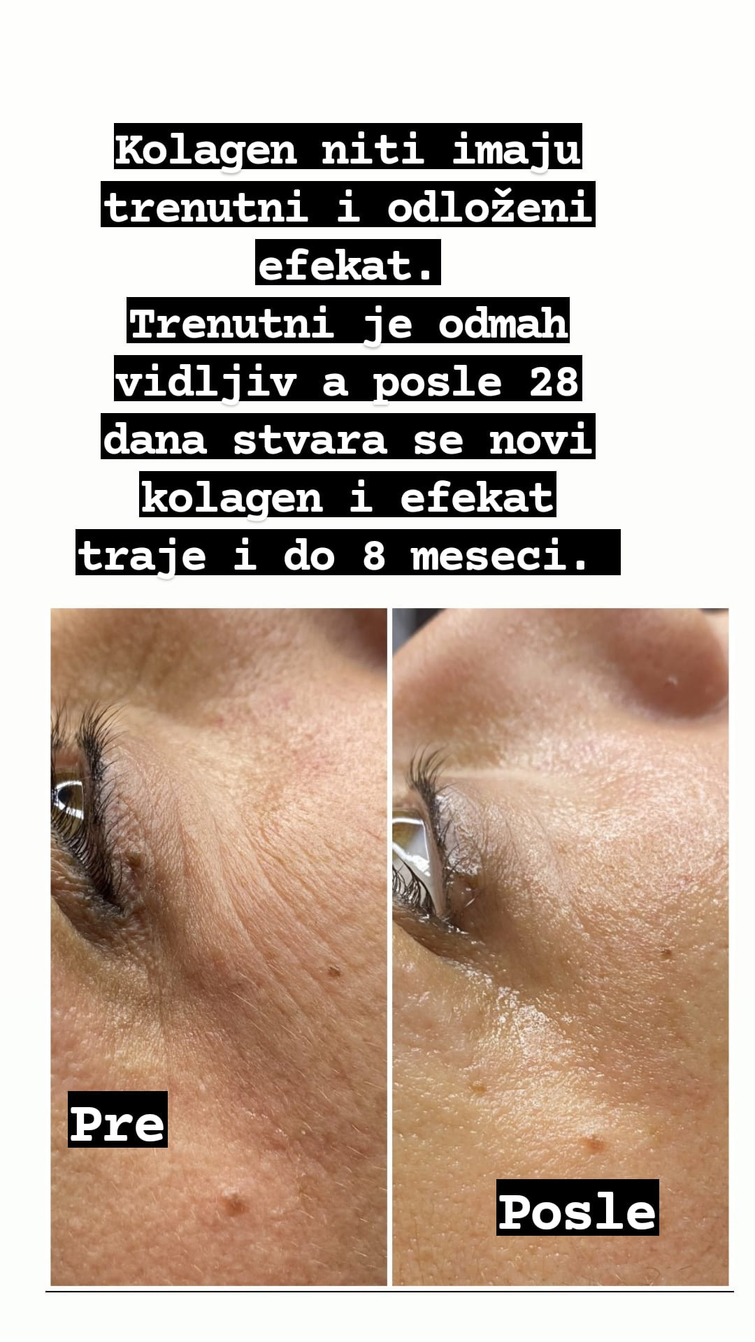 Kolagen niti - lice - Ceragem Relax, Kruševac Tretman lica Lice Tretman lica, Kruševac, Centar