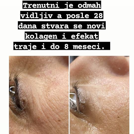 Ceragem Relax #krusevac Tretman lica Kolagen niti - lice