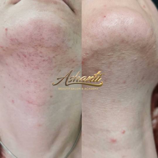 Ashanti Beauty Salon & Academy #beograd Laserska epilacija Laserska epilacija brade + podbrade Rezul