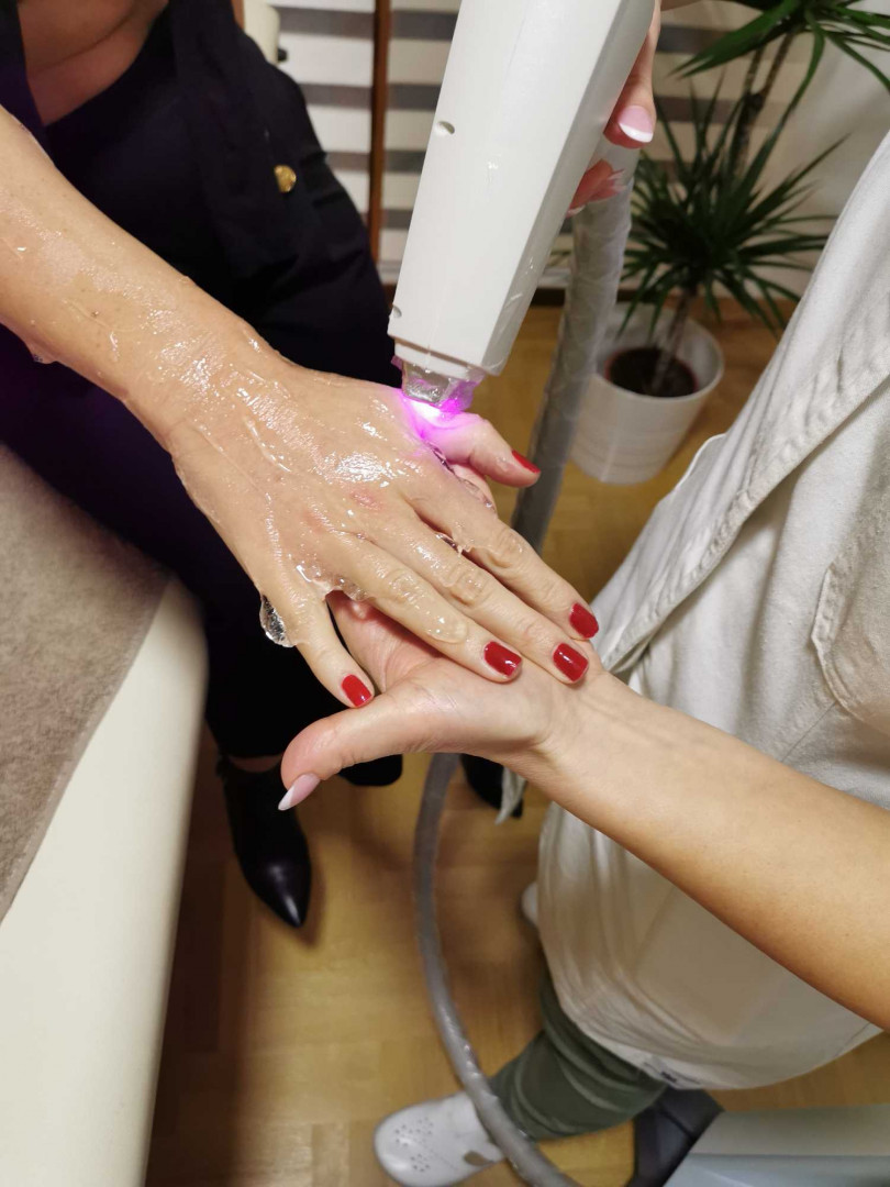 D&D Beauty Center #beograd Laserska epilacija Laserska epilacija celih ruku - za dame