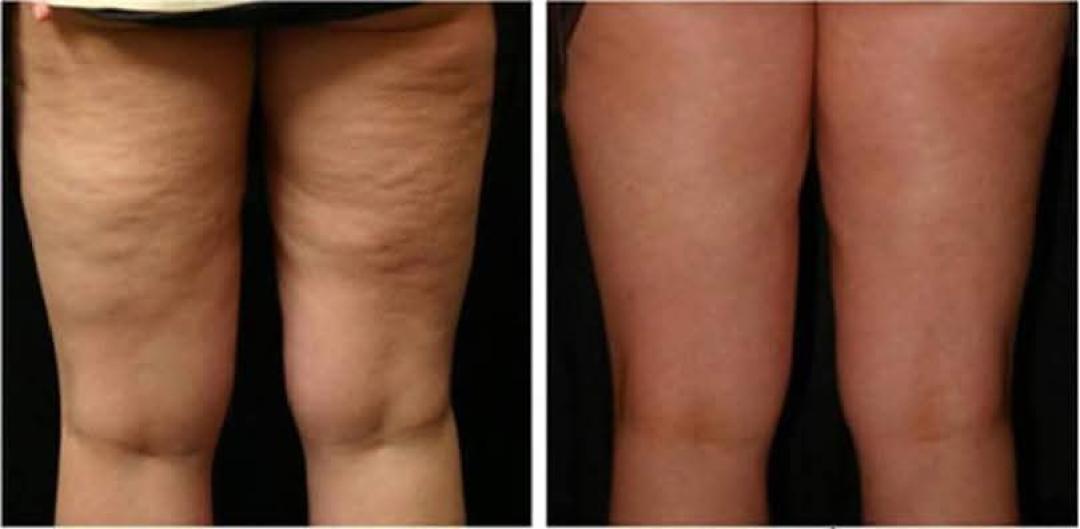 Anticelulit masaža - Astradas 2, Beograd Anticelulit masaža Masaža Anticelulit masaža, Beograd, Novi Beograd blokovi, Belville, Savski kej