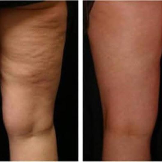 Astradas 2 #beograd Anticelulit masaža Anticelulit masaža