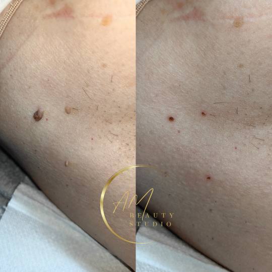 AM BEAUTY STUDIO #odzaci Tretman lica Uklanjanje papiloma