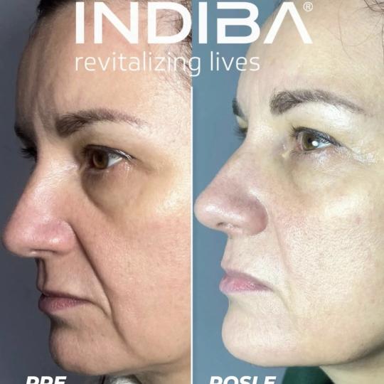 Touch Aesthetic&Medical care #beograd Radiotalasni i ultrazvučni tretmani Lice