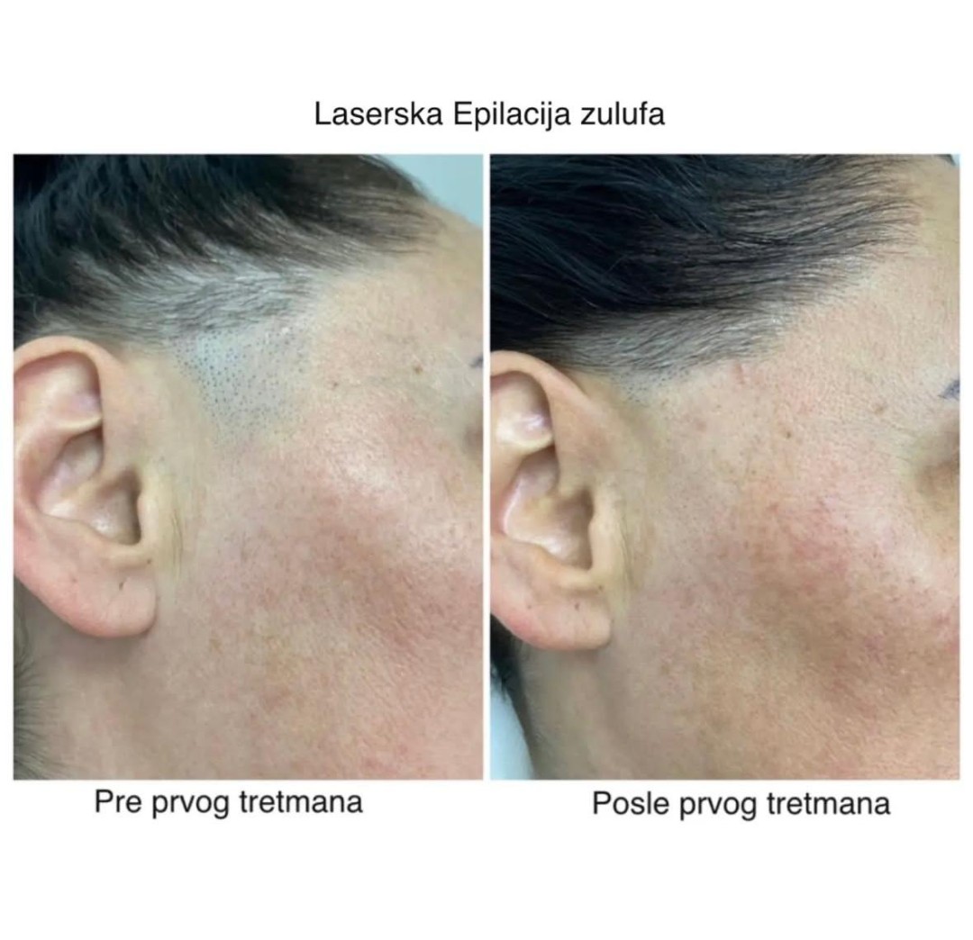 Laserska epilacija zulufa - za dame - Sylk Wax, Jagodina Laserska epilacija Depilacija Laserska epilacija, Jagodina, Centar