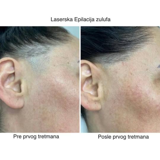 Sylk Wax #jagodina Laserska epilacija Laserska epilacija zulufa - za dame