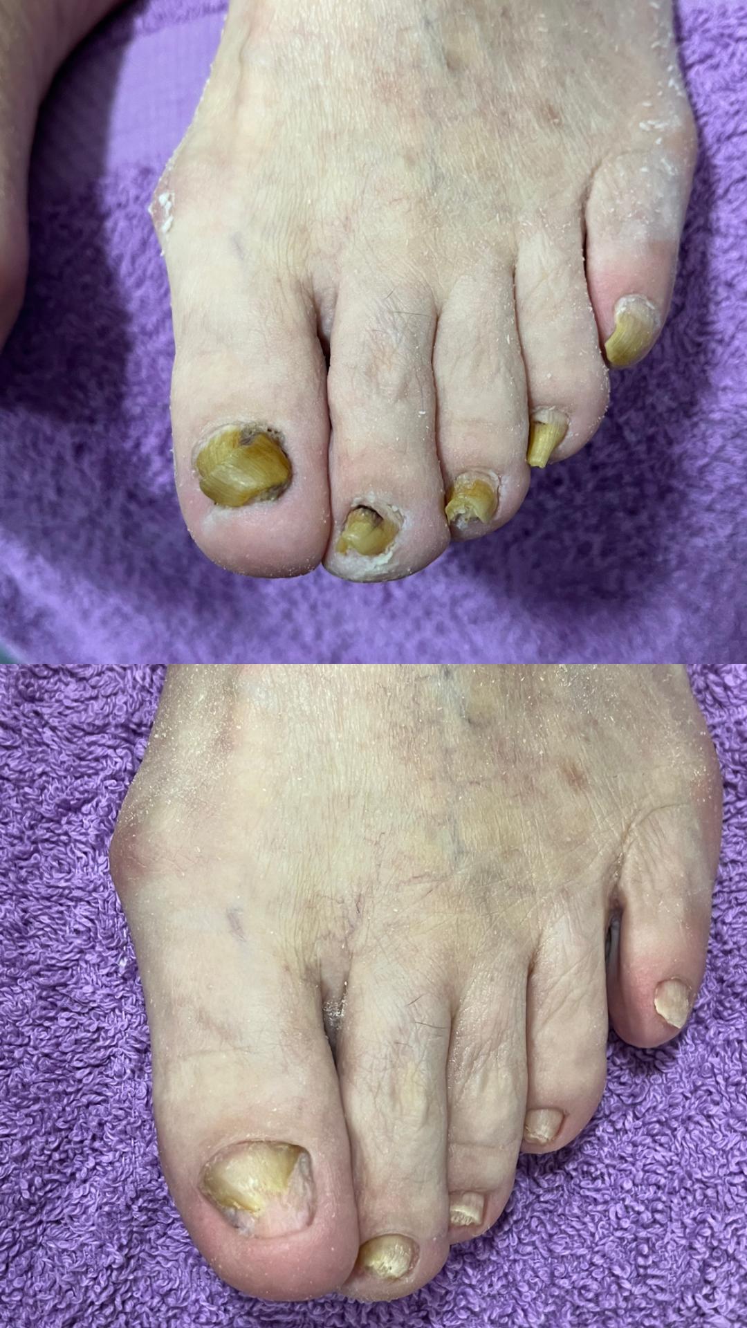 Obrada žuljeva /kurije oko /gljivice - Studio Moldovan, Beograd Gljivice na noktima Nokti Gljivice na noktima, Beograd, Zemun Centar