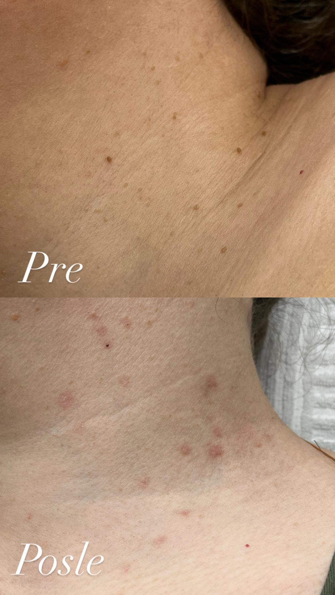 Belle Ana #beograd Tretman lica Phi-Ion tretman - bradavice / papilomi / keratoze / milije / hiperpigmentacija