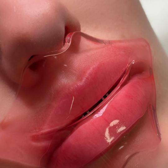 L’Avenue #beograd Mezoterapija lica Hydralips-mezoterapija usana hijaluronom