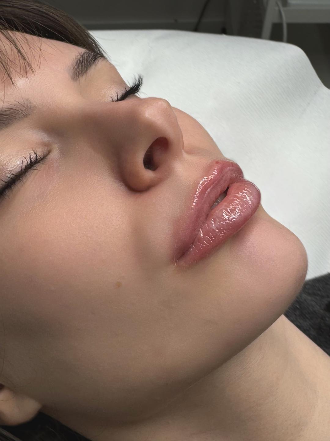 Hydralips-mezoterapija usana hijaluronom - L’Avenue, Beograd Mezoterapija lica Lice Mezoterapija lica, Beograd, Centar, Stari grad, Dorćol