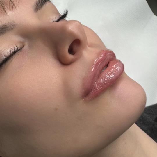 L’Avenue #beograd Mezoterapija lica Hydralips-mezoterapija usana hijaluronom