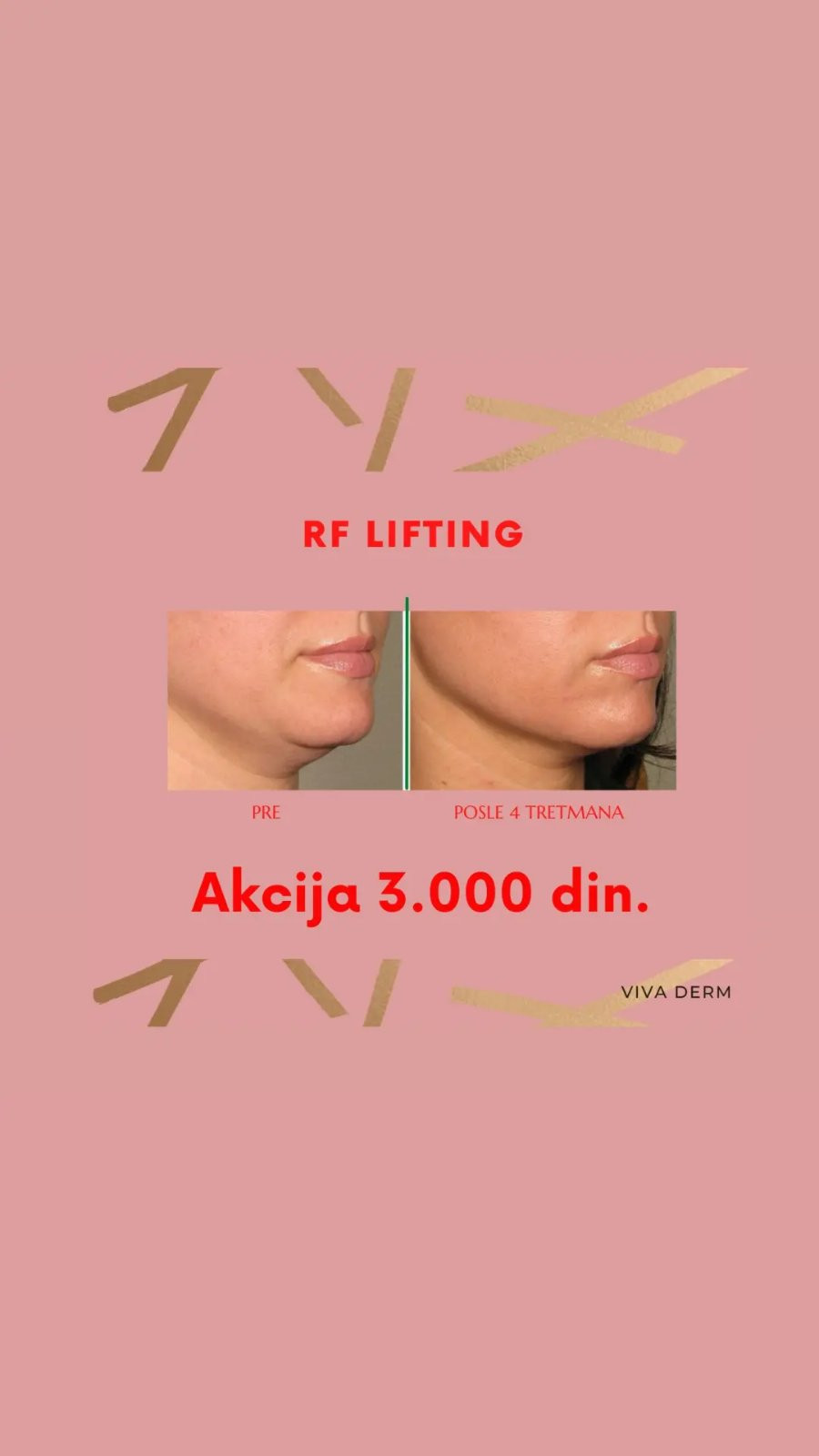Viva Derm #beograd Radiotalasni i ultrazvučni tretmani RF lifting - lice + vrat + dekolte