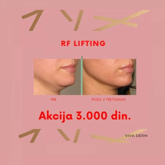 Viva Derm #beograd Radiotalasni i ultrazvučni tretmani RF lifting - lice + vrat + dekolte