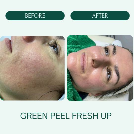 Noir #beograd Tretman lica Green peel - Fresh up Green Peel Fresh Up tretman je prirodan i efikasan 