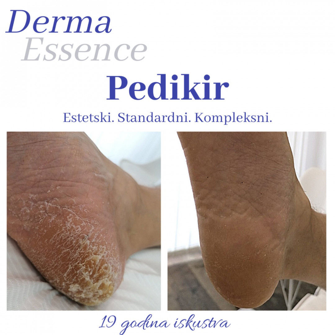 Derma Essence #nis Medicinski pedikir Kompleksni medicinski pedikir