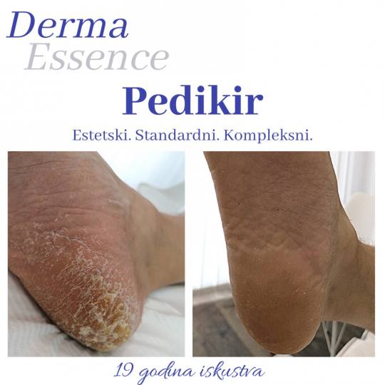 Derma Essence #nis Medicinski pedikir Kompleksni medicinski pedikir