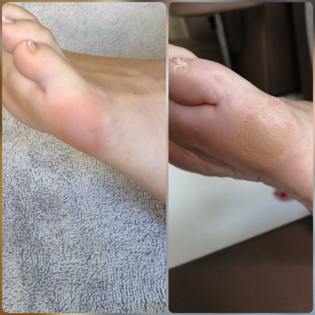 Skin Expert Aesthetic & Laser centar #beograd Medicinski pedikir Medicinski pedikir + lakiranje noktiju gratis