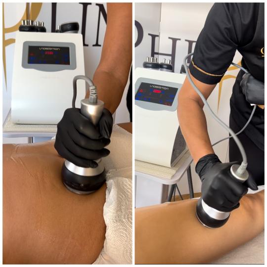 Belle Ana #beograd Kavitacija Kavitacija - stomak