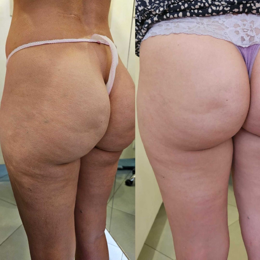 Choco Love #beograd Tretmani tela Mezoporacija tela bez igle - gluteus + cele noge