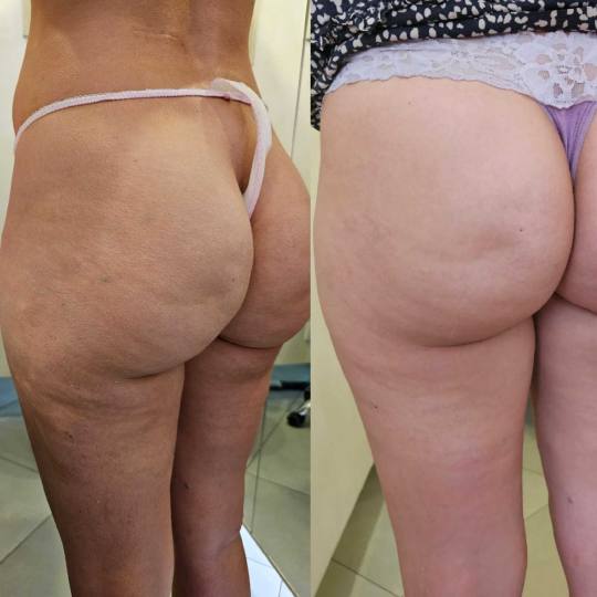Choco Love #beograd Tretmani tela Mezoporacija tela bez igle - gluteus + cele noge
