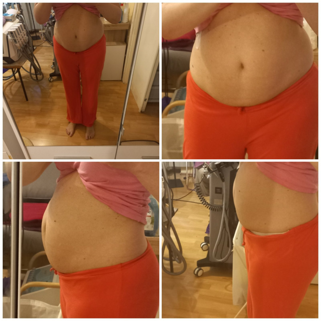 21 Beauty Centar #beograd Tretmani tela Lipo laser