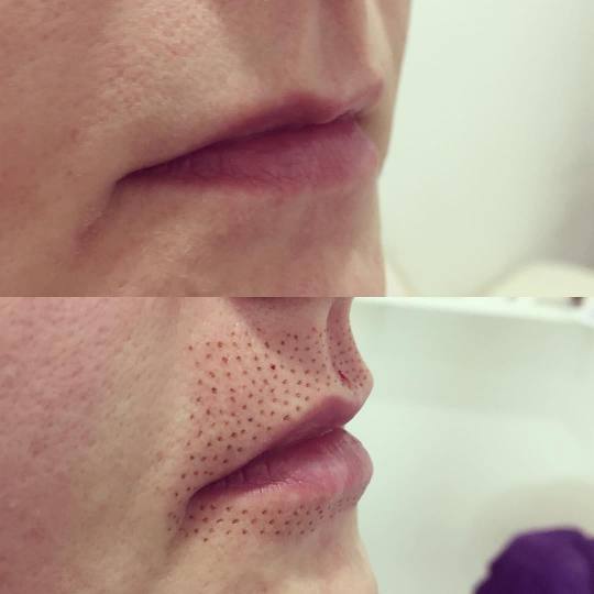 Ashanti Beauty Salon & Academy #beograd Tretman lica Plasma pen -  lip flip usne