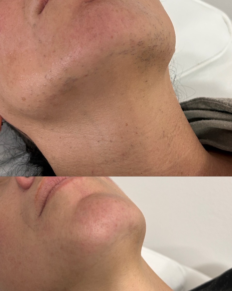 Lash & Light Studio #beograd Laserska epilacija Laserska epilacija podbratka - za dame