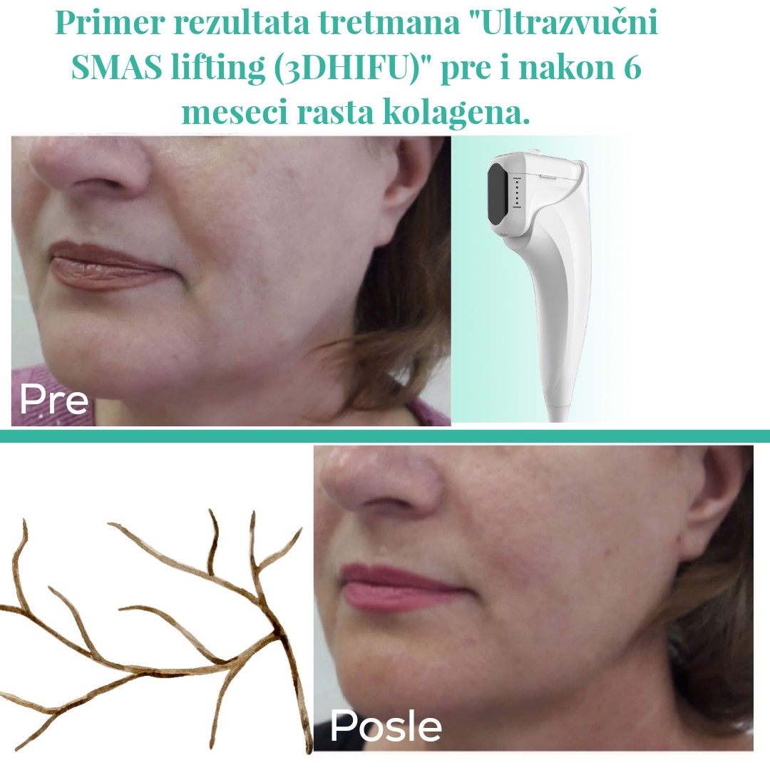 Vita Elos #novisad Lifting / zatezanje kože Ultrazvučni SMAS lifting (3D HIFU tehnologija) - celog lica