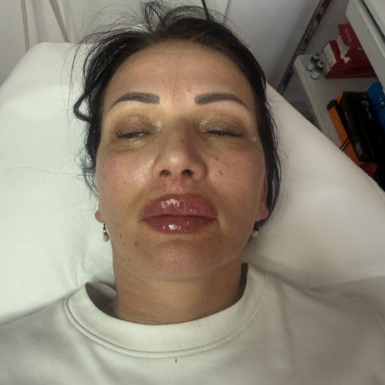 Apolona #beograd Dermalni fileri Hijaluronski fileri Hijaluronski fileri za usta su jedan od najpopu