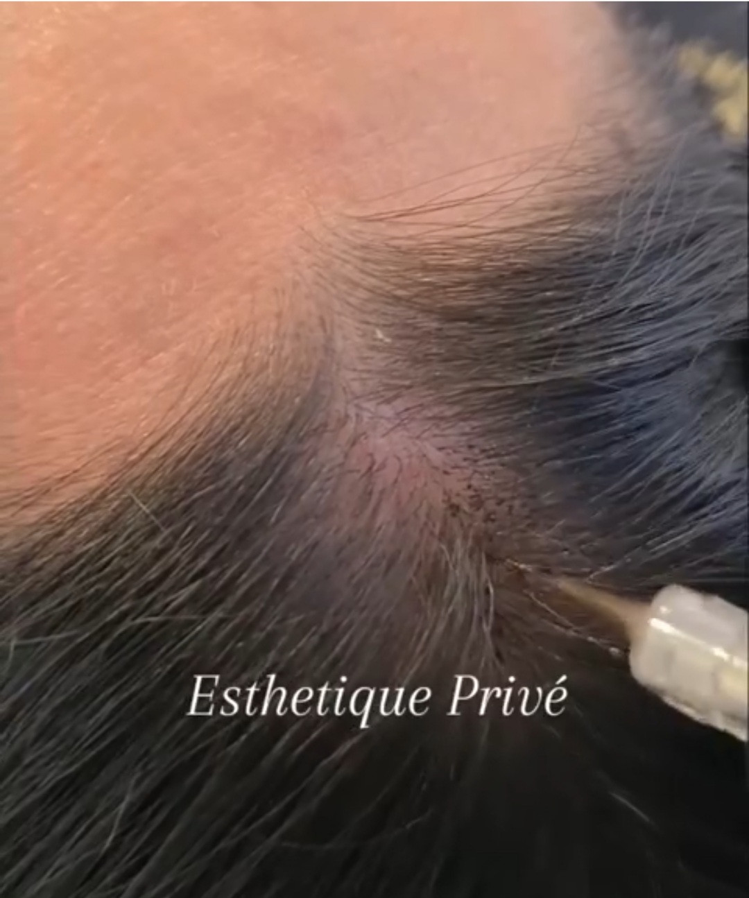 Esthetique Privé #beograd Trajna šminka Scalp Micropigmentation po regiji