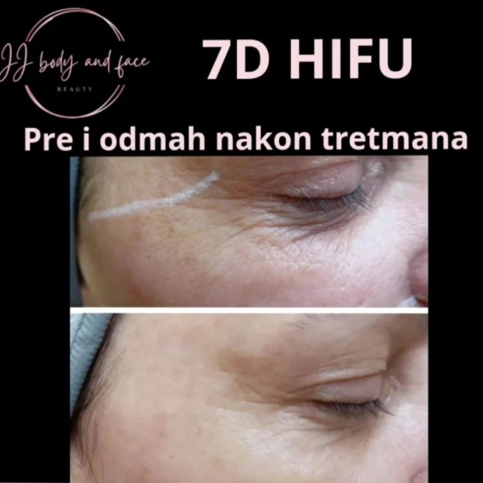 Beauty by Sanja #novisad Nega i ojačavanje kose Hifu 7D SMAS - tretman lica