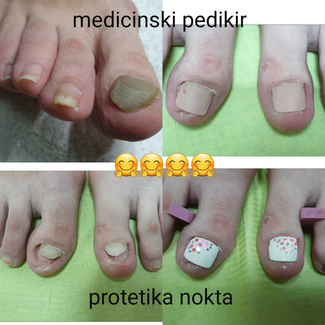 Tina B #beograd Medicinski pedikir Medicinski pedikir - gljivični / oboleli nokti