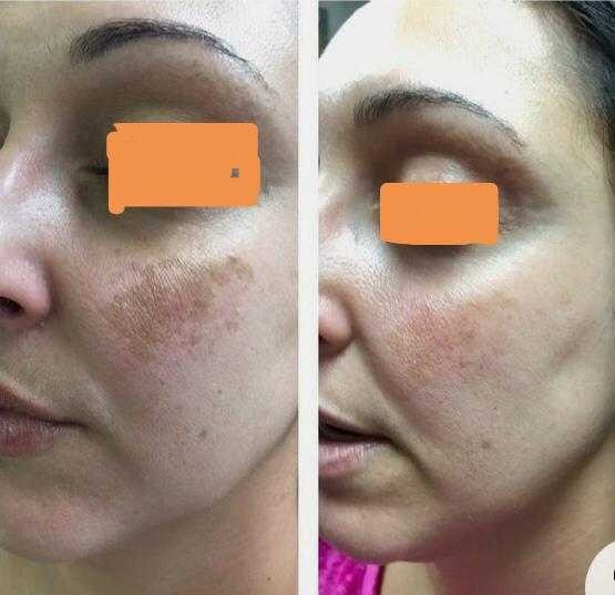 First lady #beograd Mezoterapija lica Mezoterapija lica dermapenom - protiv hiperpigmentacije
