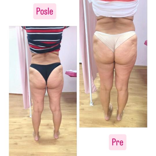 Mademoiselle Natalie studio #beograd Anticelulit LUX 10 maderoterapije+10 limfne drenaze+ brazilske 