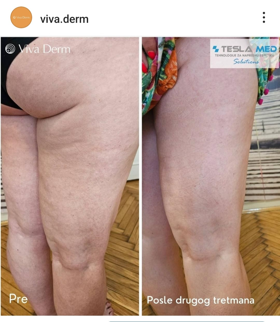 Viva Derm #beograd Tretmani tela Tesla MED - Dermaresurface (uklanjanje celulita)