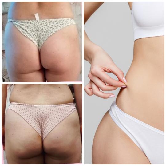 Belle Ana #beograd Tretmani tela EMS tretman - 2 regije