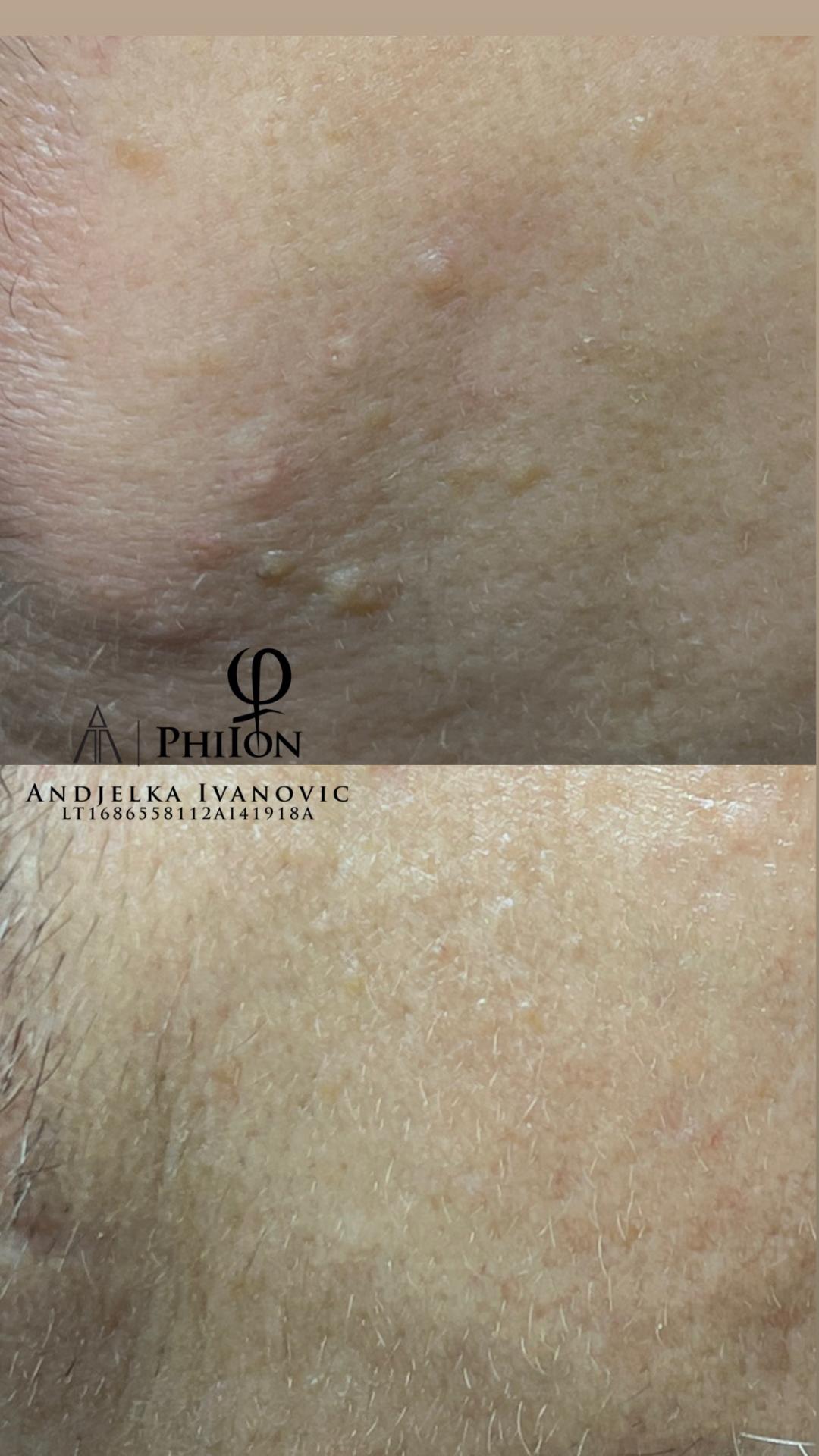 Belle Ana #beograd Tretman lica Phi-Ion tretman - bradavice / papilomi / keratoze / milije / hiperpigmentacija