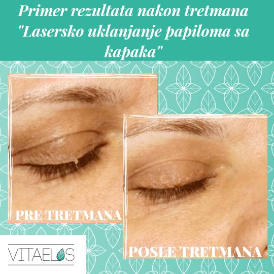Vita Elos #novisad Laserski tretmani lica Uklanjanje papiloma sa kapaka Rezultate tretmana Uklanjanj
