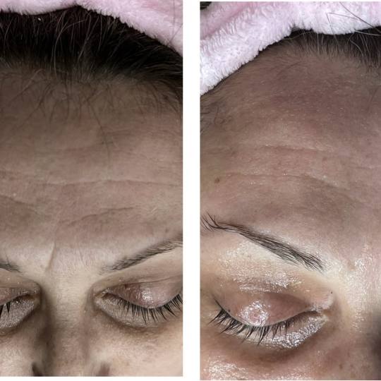 Beauty and nutrition #beograd Tretman lica Kolagen niti celo lice Podmladjivanje lica,vrata i dekolt