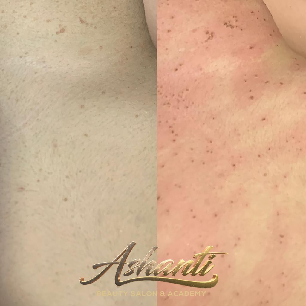 Uklanjanje virusnih bradavica - Ashanti Beauty Salon & Academy, Beograd Tretman lica Lice Tretman lica, Beograd, Voždovac